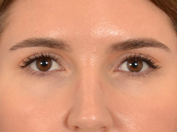 Eyelid Lift Before & After Gallery - Patient 458909 - Image 1