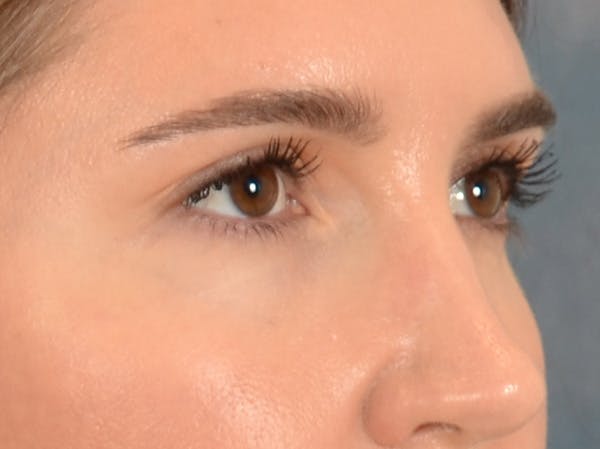 Eyelid Lift Before & After Gallery - Patient 458909 - Image 3