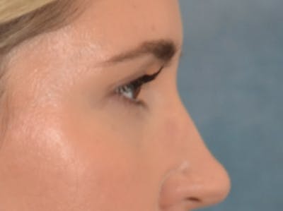 Eyelid Lift Before & After Gallery - Patient 458909 - Image 6