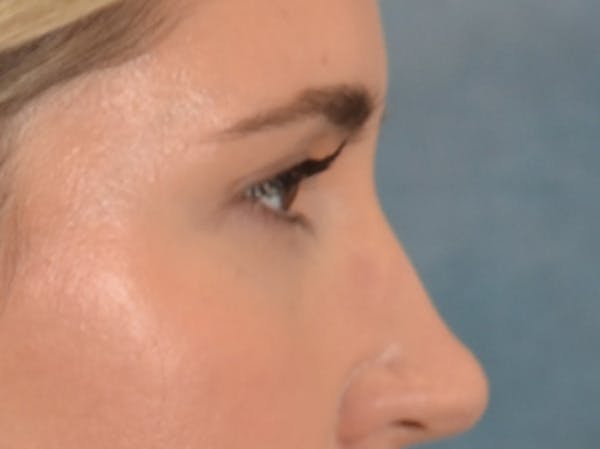 Eyelid Lift Before & After Gallery - Patient 458909 - Image 6