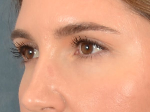 Eyelid Lift Before & After Gallery - Patient 458909 - Image 7