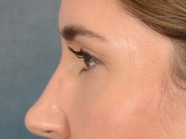 Eyelid Lift Before & After Gallery - Patient 458909 - Image 9