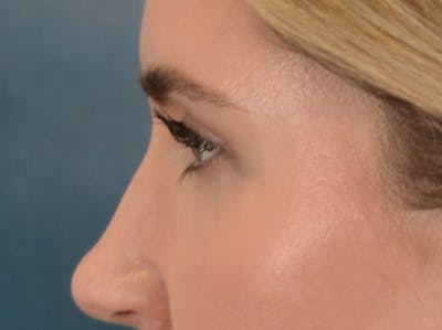 Eyelid Lift Before & After Gallery - Patient 458909 - Image 10