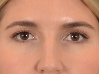 Eyelid Lift Before & After Gallery - Patient 458909 - Image 2