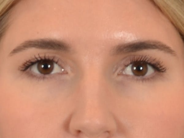 Eyelid Lift Before & After Gallery - Patient 458909 - Image 2