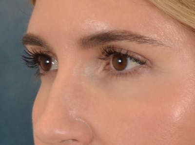 Eyelid Lift Before & After Gallery - Patient 458909 - Image 8