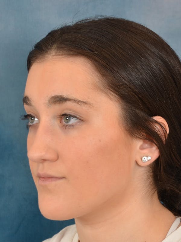Rhinoplasty Before & After Gallery - Patient 638151 - Image 3