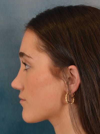 Rhinoplasty Before & After Gallery - Patient 638151 - Image 2