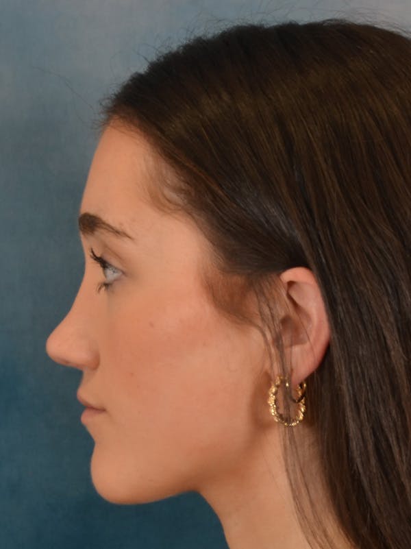 Rhinoplasty Before & After Gallery - Patient 638151 - Image 2