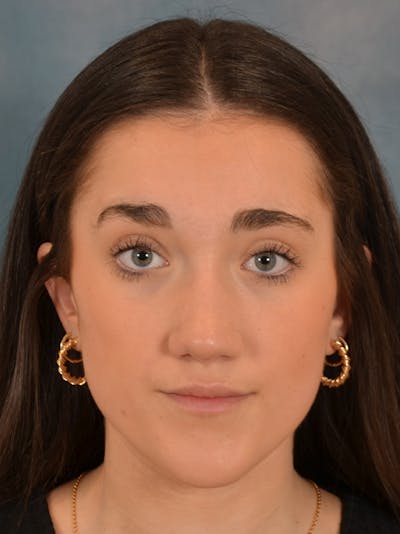 Rhinoplasty Before & After Gallery - Patient 638151 - Image 6