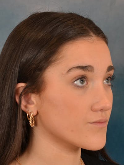 Rhinoplasty Before & After Gallery - Patient 638151 - Image 8