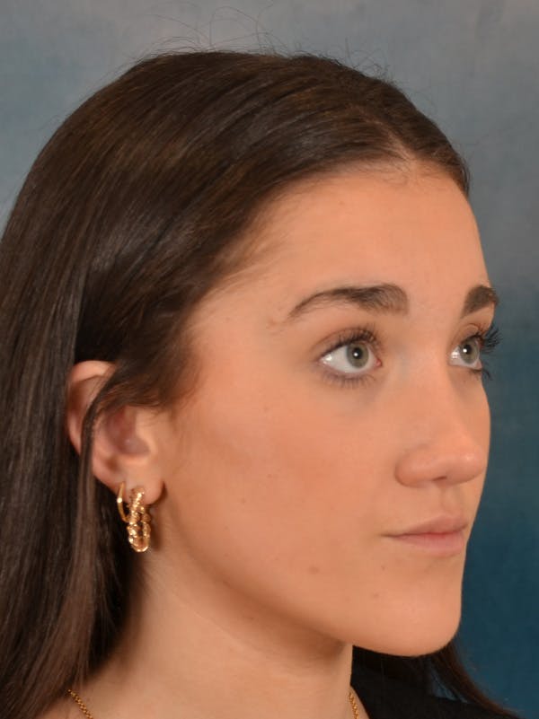 Rhinoplasty Before & After Gallery - Patient 638151 - Image 8