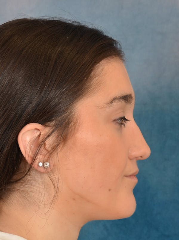 Rhinoplasty Before & After Gallery - Patient 638151 - Image 9