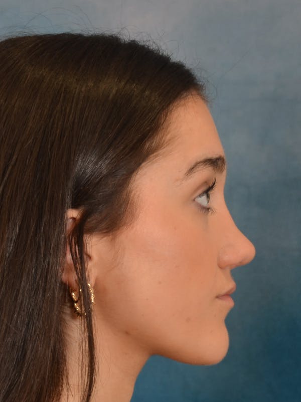 Rhinoplasty Before & After Gallery - Patient 638151 - Image 10