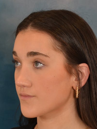 Rhinoplasty Before & After Gallery - Patient 638151 - Image 4