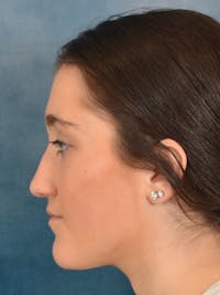 Rhinoplasty Before & After Gallery - Patient 638151 - Image 1