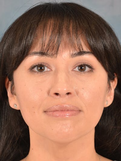 Deep Neck Lift Before & After Gallery - Patient 121070 - Image 1