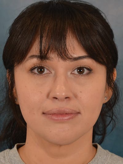 Deep Neck Lift Before & After Gallery - Patient 121070 - Image 2