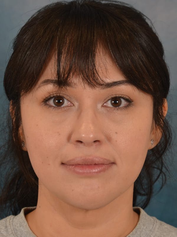 Deep Neck Lift Before & After Gallery - Patient 121070 - Image 2