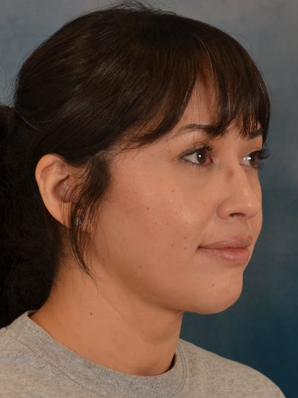 Deep Neck Lift Before & After Gallery - Patient 121070 - Image 4