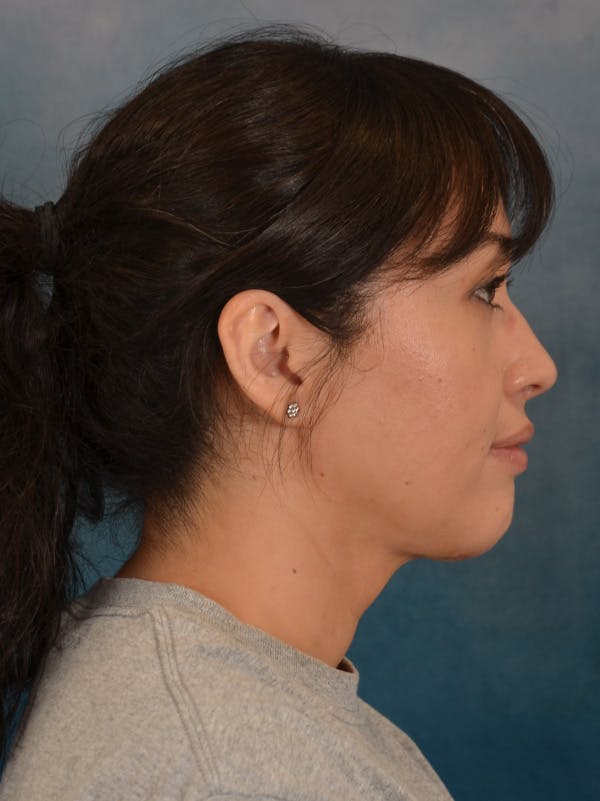 Deep Neck Lift Before & After Gallery - Patient 121070 - Image 6