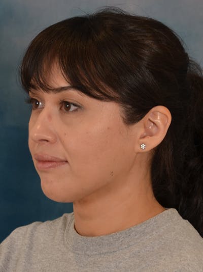 Deep Neck Lift Before & After Gallery - Patient 121070 - Image 8