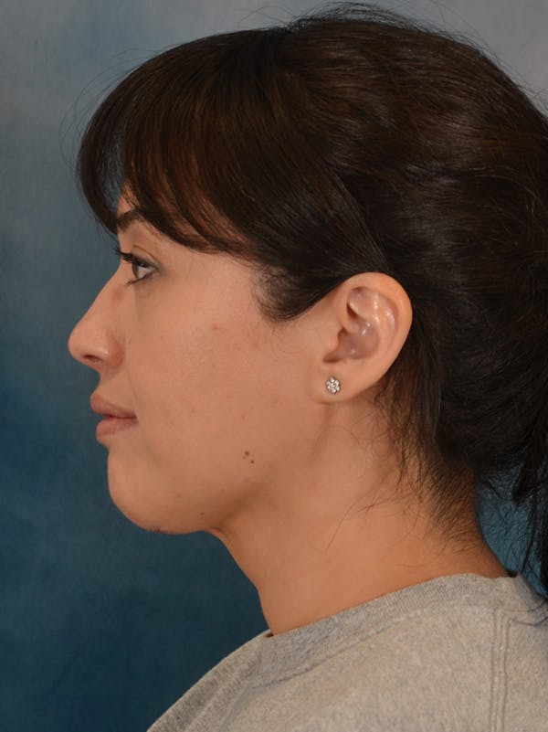 Deep Neck Lift Before & After Gallery - Patient 121070 - Image 10
