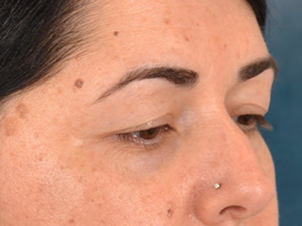 Brow Lift Before & After Gallery - Patient 285204 - Image 3