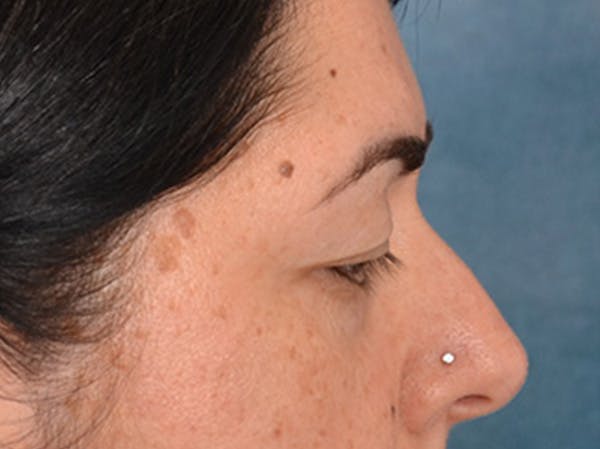Brow Lift Before & After Gallery - Patient 285204 - Image 5