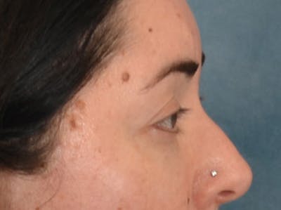 Brow Lift Before & After Gallery - Patient 285204 - Image 6