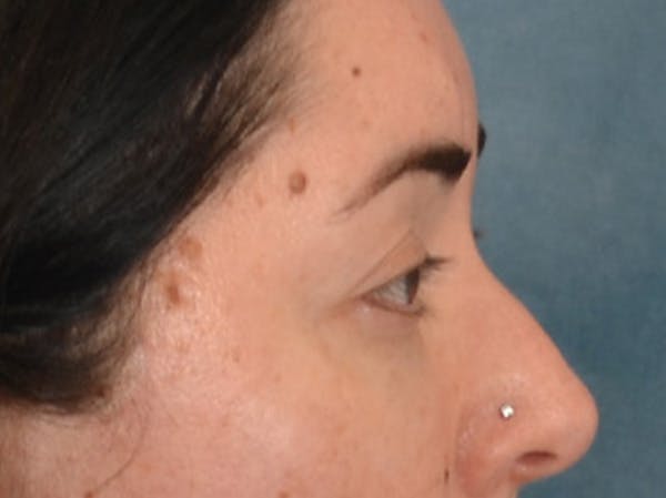 Brow Lift Before & After Gallery - Patient 285204 - Image 6
