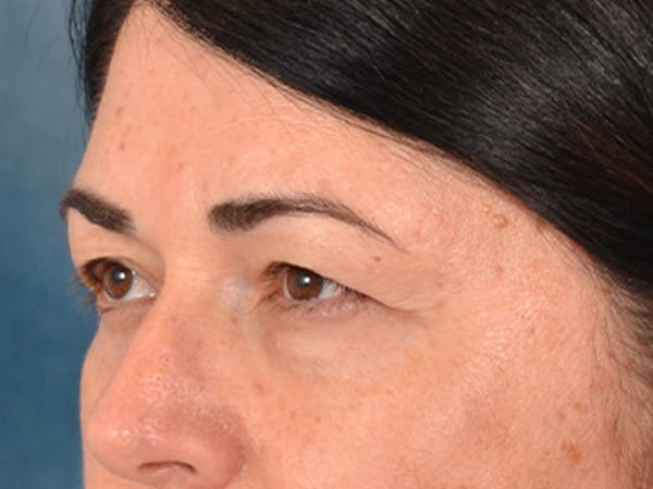 Brow Lift Before & After Gallery - Patient 285204 - Image 7