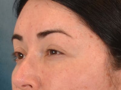 Brow Lift Before & After Gallery - Patient 285204 - Image 8