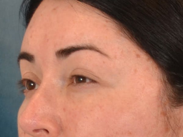 Brow Lift Before & After Gallery - Patient 285204 - Image 8