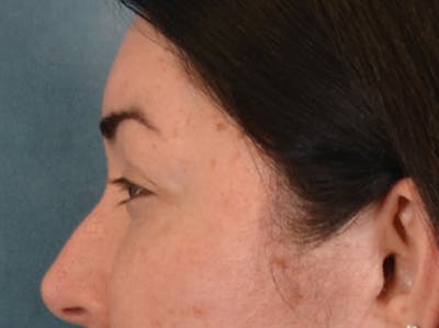 Brow Lift Before & After Gallery - Patient 285204 - Image 10