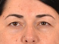 Brow Lift Before & After Gallery - Patient 285204 - Image 1