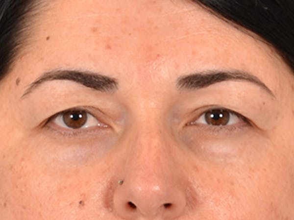 Brow Lift Before & After Gallery - Patient 285204 - Image 1