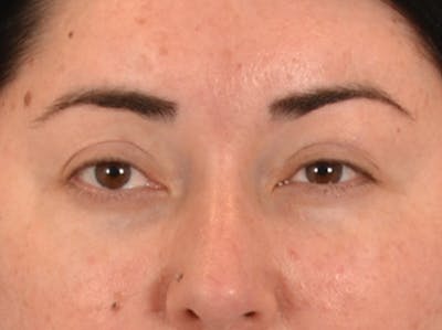 Brow Lift Before & After Gallery - Patient 285204 - Image 2