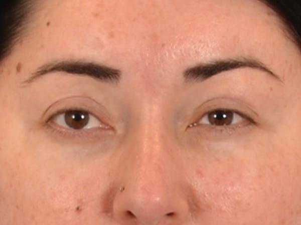 Brow Lift Before & After Gallery - Patient 285204 - Image 2