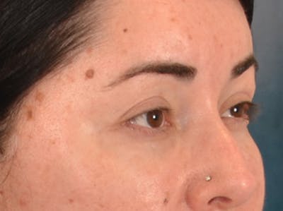 Brow Lift Before & After Gallery - Patient 285204 - Image 4