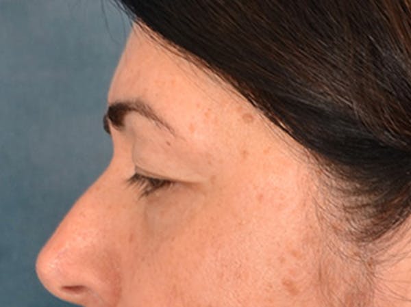 Brow Lift Before & After Gallery - Patient 285204 - Image 9