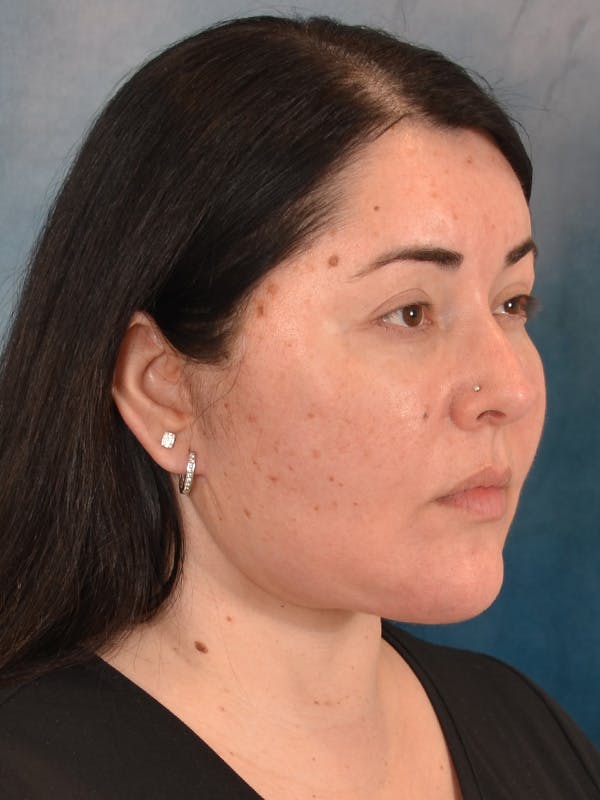 Laser Skin Resurfacing Before & After Gallery - Patient 271506 - Image 4