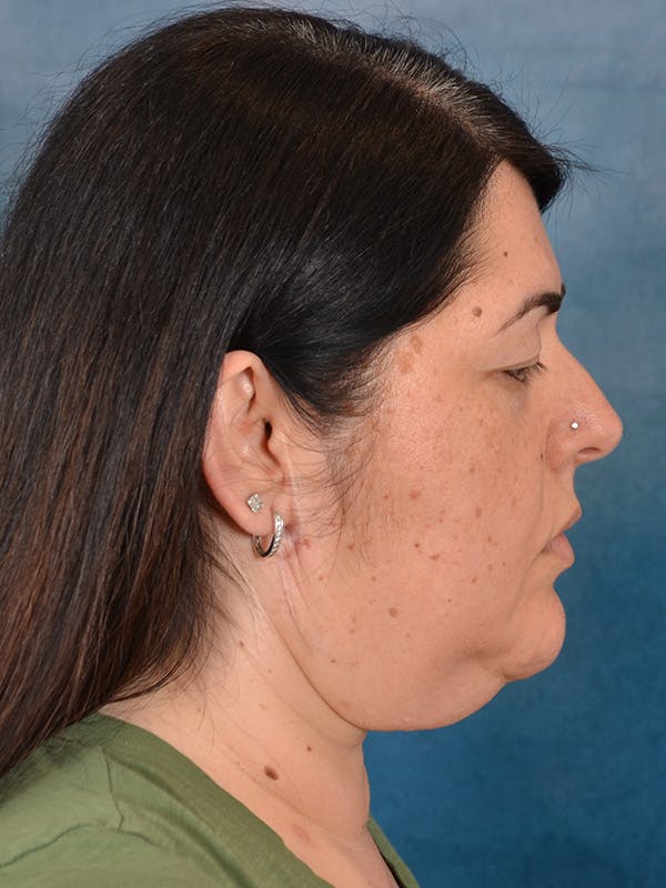 Laser Skin Resurfacing Before & After Gallery - Patient 271506 - Image 5