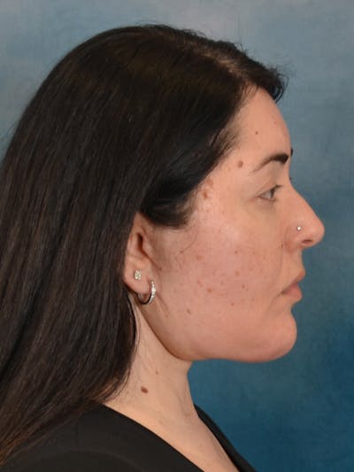 Laser Skin Resurfacing Before & After Gallery - Patient 271506 - Image 6