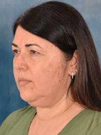 Deep Plane Facelift Before & After Gallery - Patient 183994 - Image 1