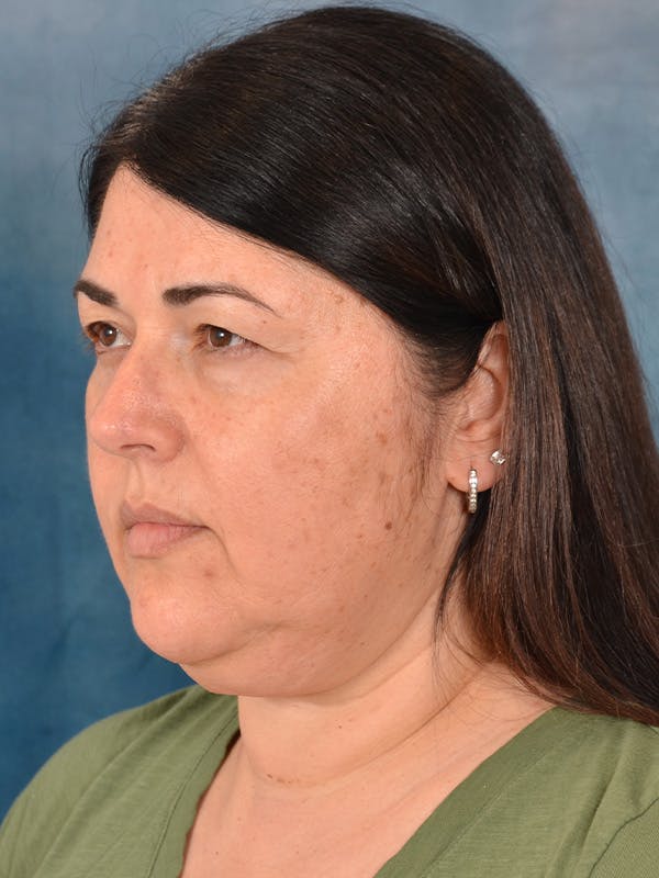 Laser Skin Resurfacing Before & After Gallery - Patient 271506 - Image 7
