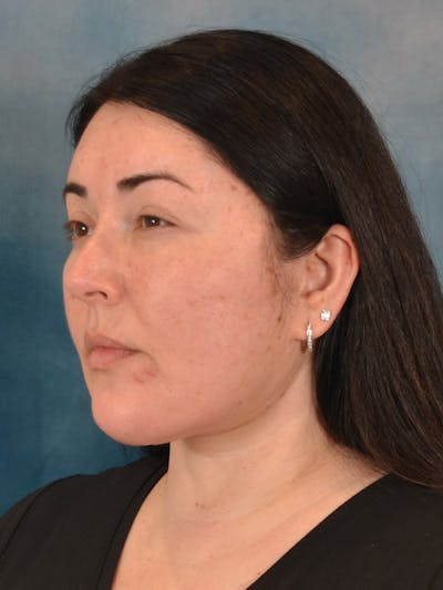 Laser Skin Resurfacing Before & After Gallery - Patient 271506 - Image 8