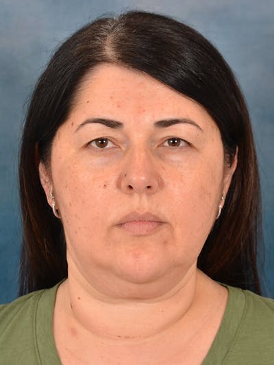 Laser Skin Resurfacing Before & After Gallery - Patient 271506 - Image 1