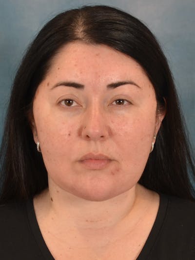 Laser Skin Resurfacing Before & After Gallery - Patient 271506 - Image 2