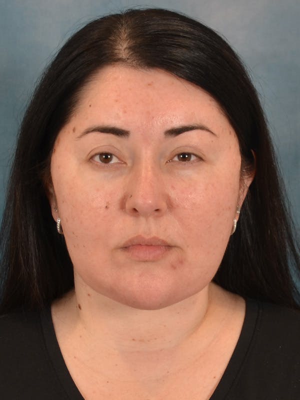 Laser Skin Resurfacing Before & After Gallery - Patient 271506 - Image 2